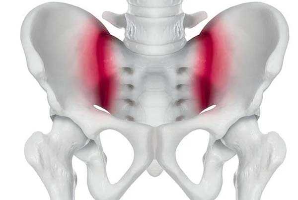 SI Joint Arthropathy And Sacroiliitis