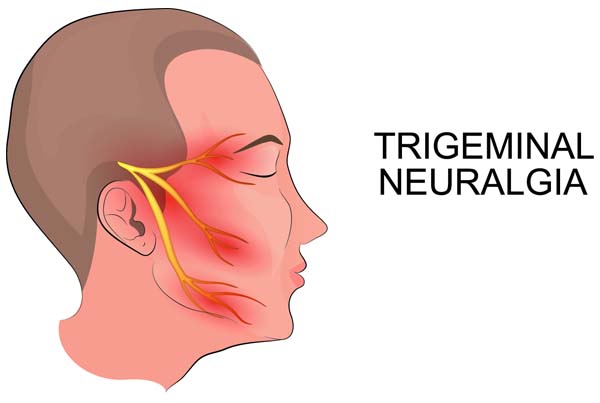 Trigeminal Neuralgia