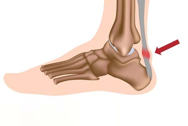 Achilles Tendinopathy