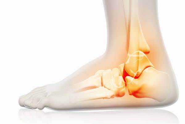 Ankle Arthritis