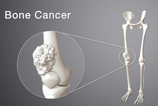 Oncology - Bone Tumor