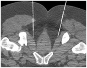 Pudendalgia Pudendal block